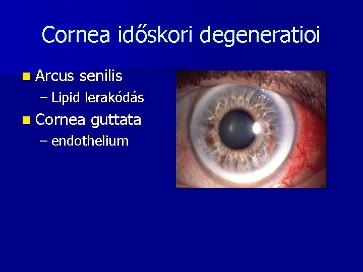 Cornea időskori degeneratioi n Arcus senilis – Lipid lerakódás n Cornea guttata – endothelium