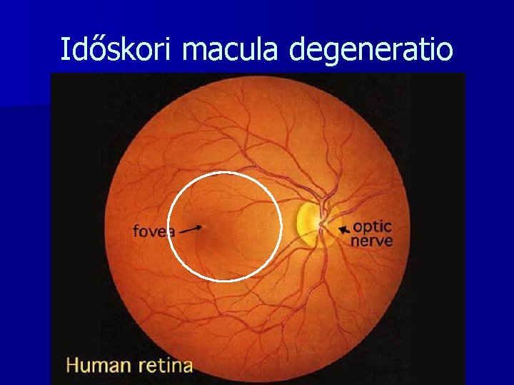 Időskori macula degeneratio 