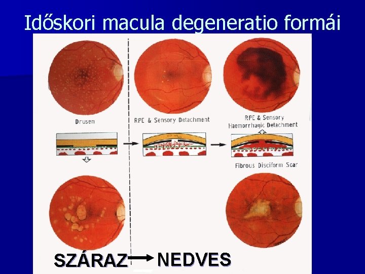 Időskori macula degeneratio formái SZÁRAZ NEDVES 