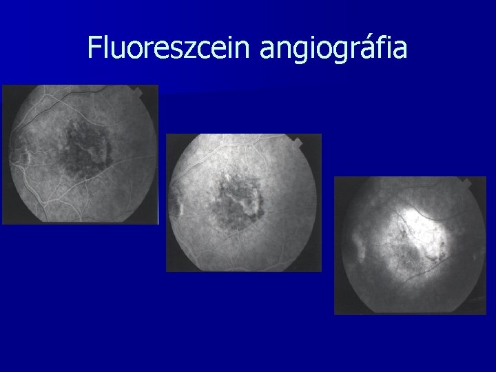 Fluoreszcein angiográfia 