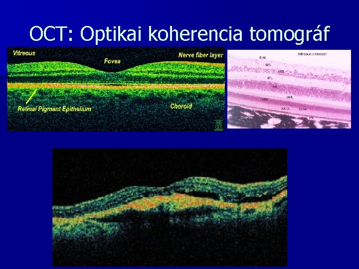 OCT: Optikai koherencia tomográf 