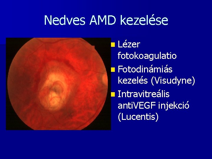 Nedves AMD kezelése n Lézer fotokoagulatio n Fotodinámiás kezelés (Visudyne) n Intravitreális anti. VEGF