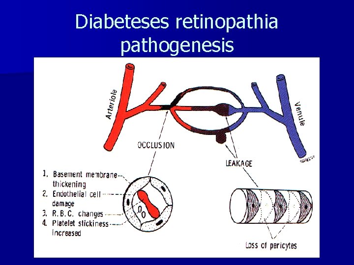 Diabeteses retinopathia pathogenesis 