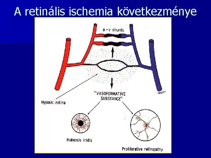 A retinális ischemia következménye 