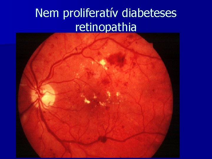 Nem proliferatív diabeteses retinopathia 