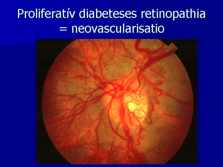 Proliferatív diabeteses retinopathia = neovascularisatio 