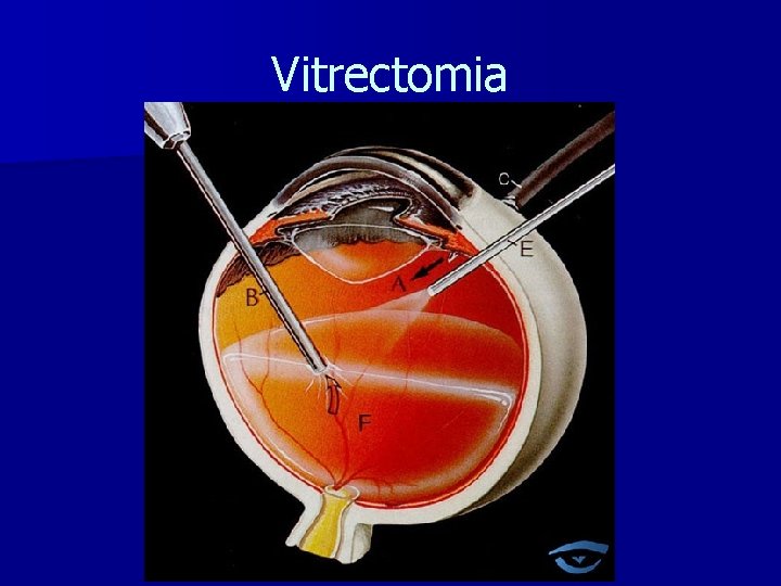 Vitrectomia 
