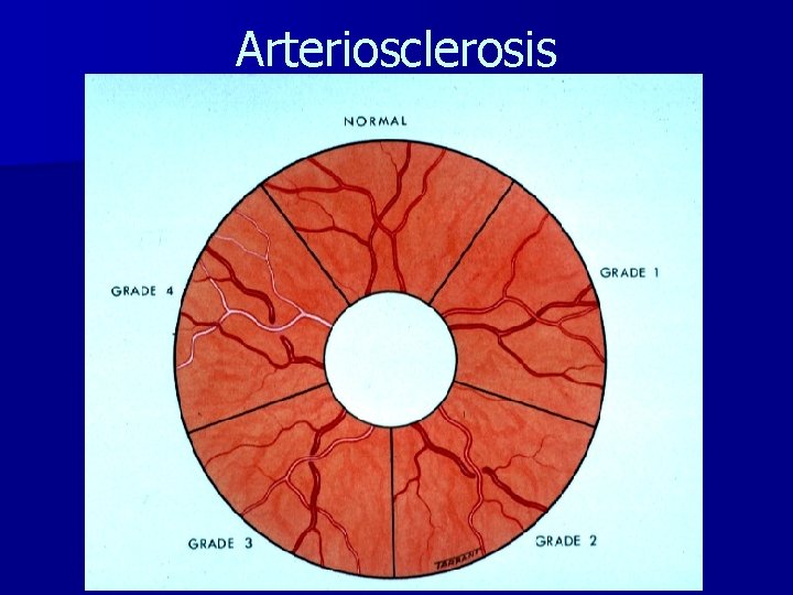 Arteriosclerosis 