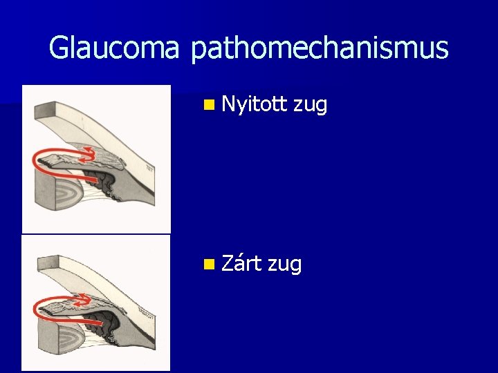 Glaucoma pathomechanismus n Nyitott n Zárt zug 