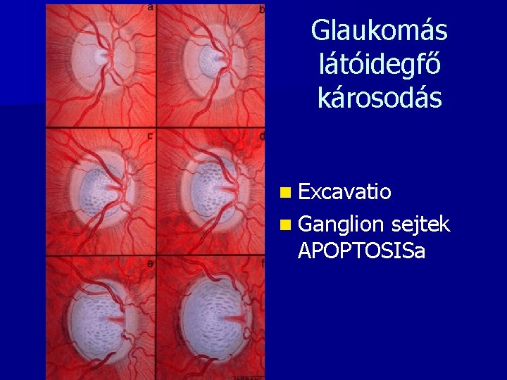 Glaukomás látóidegfő károsodás n Excavatio n Ganglion sejtek APOPTOSISa 