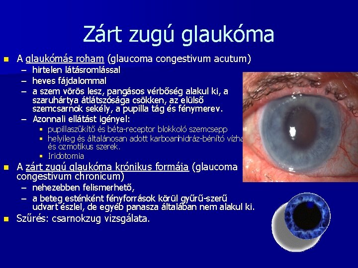Zárt zugú glaukóma n A glaukómás roham (glaucoma congestivum acutum) – hirtelen látásromlással –