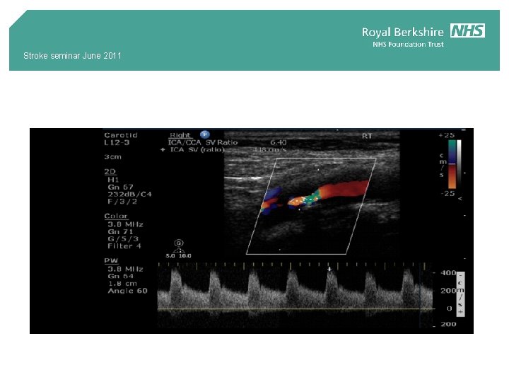 Stroke seminar June 2011 