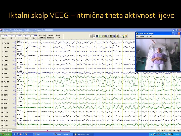 Iktalni skalp VEEG – ritmična theta aktivnost lijevo 