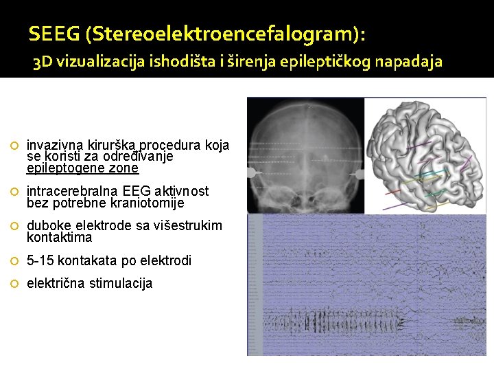 SEEG (Stereoelektroencefalogram): 3 D vizualizacija ishodišta i širenja epileptičkog napadaja invazivna kirurška procedura koja
