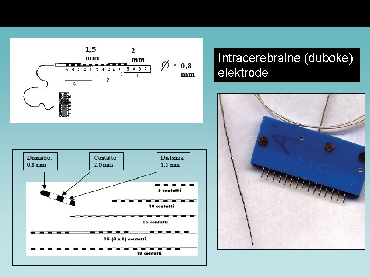 Intracerebralne (duboke) elektrode 