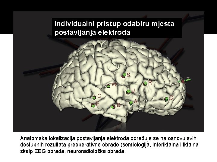 Individualni pristup odabiru mjesta postavljanja elektroda Anatomska lokalizacija postavljanja elektroda određuje se na osnovu