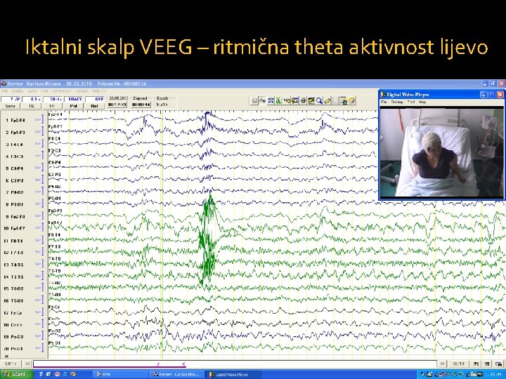 Iktalni skalp VEEG – ritmična theta aktivnost lijevo 