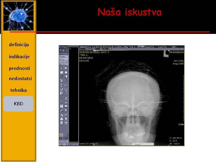 Naša iskustva definicija indikacije prednosti nedostatci tehnika KBD 