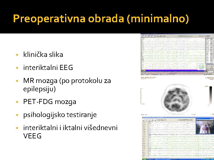 Preoperativna obrada (minimalno) • klinička slika • interiktalni EEG • MR mozga (po protokolu