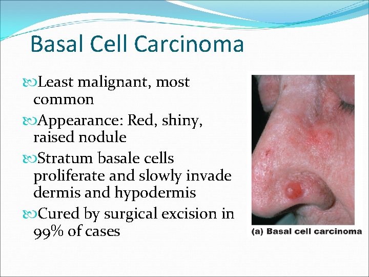 Basal Cell Carcinoma Least malignant, most common Appearance: Red, shiny, raised nodule Stratum basale