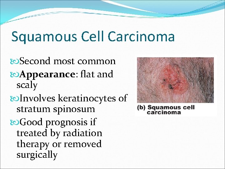 Squamous Cell Carcinoma Second most common Appearance: flat and scaly Involves keratinocytes of stratum