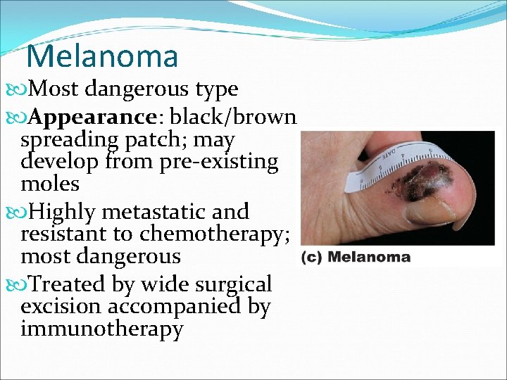 Melanoma Most dangerous type Appearance: black/brown spreading patch; may develop from pre-existing moles Highly