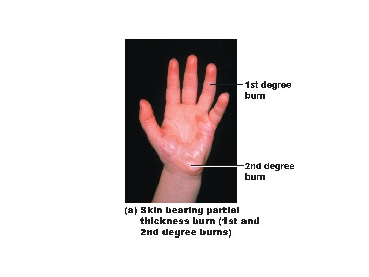 1 st degree burn 2 nd degree burn (a) Skin bearing partial thickness burn