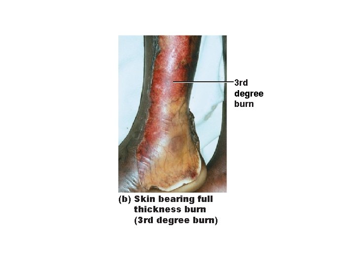 3 rd degree burn (b) Skin bearing full thickness burn (3 rd degree burn) 3 rd degree burn (b) Skin bearing full thickness burn (3 rd degree burn)