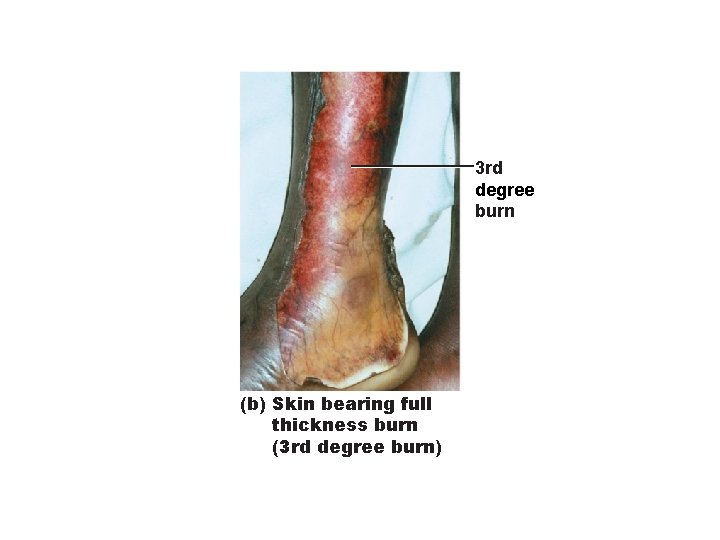 3 rd degree burn (b) Skin bearing full thickness burn (3 rd degree burn)