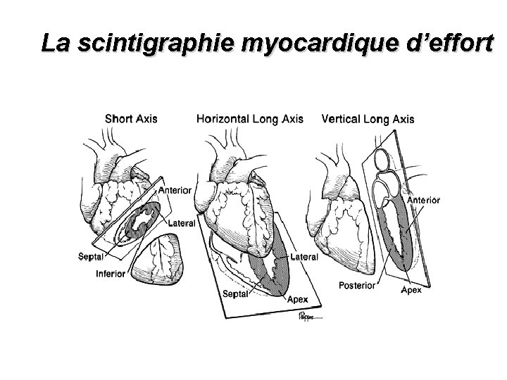 La scintigraphie myocardique d’effort 
