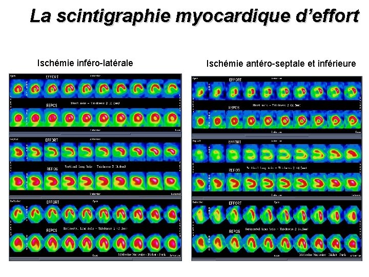 La scintigraphie myocardique d’effort Ischémie inféro-latérale Ischémie antéro-septale et inférieure 