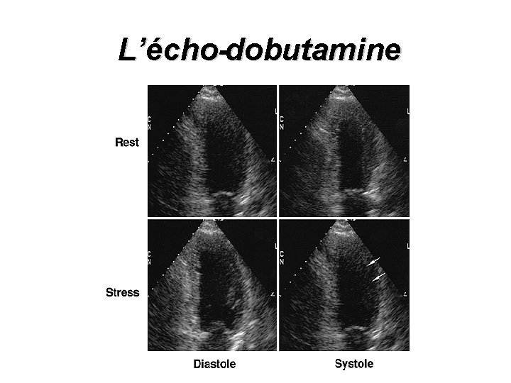 L’écho-dobutamine 