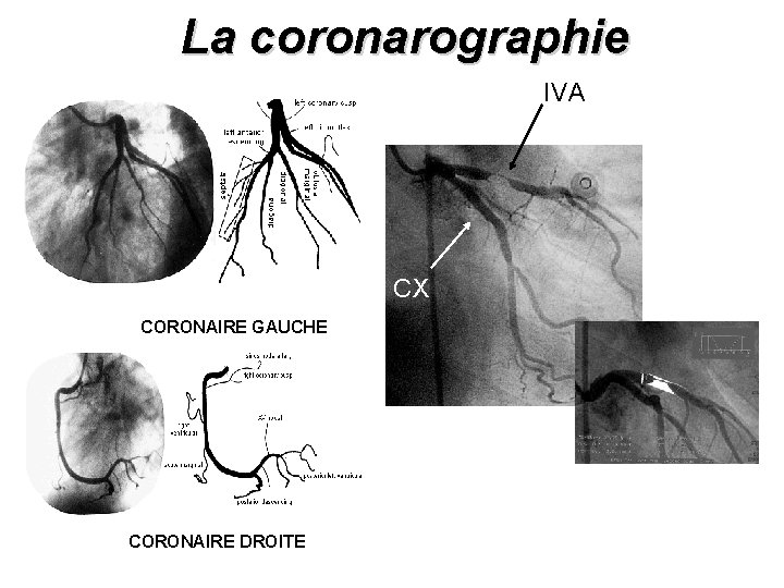 La coronarographie IVA CX CORONAIRE GAUCHE CORONAIRE DROITE 