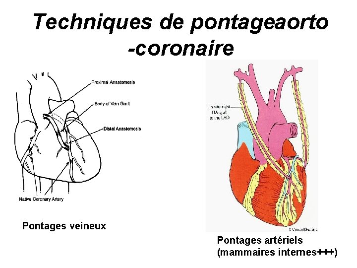 Techniques de pontage aorto -coronaire Pontages veineux Pontages artériels (mammaires internes+++) 