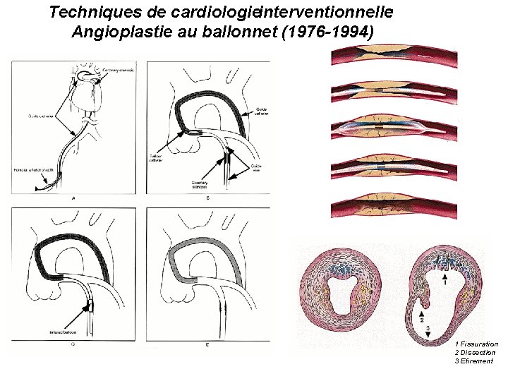 Techniques de cardiologie interventionnelle: Angioplastie au ballonnet (1976 -1994) Résultat immédiat… 1 Fissuration 2