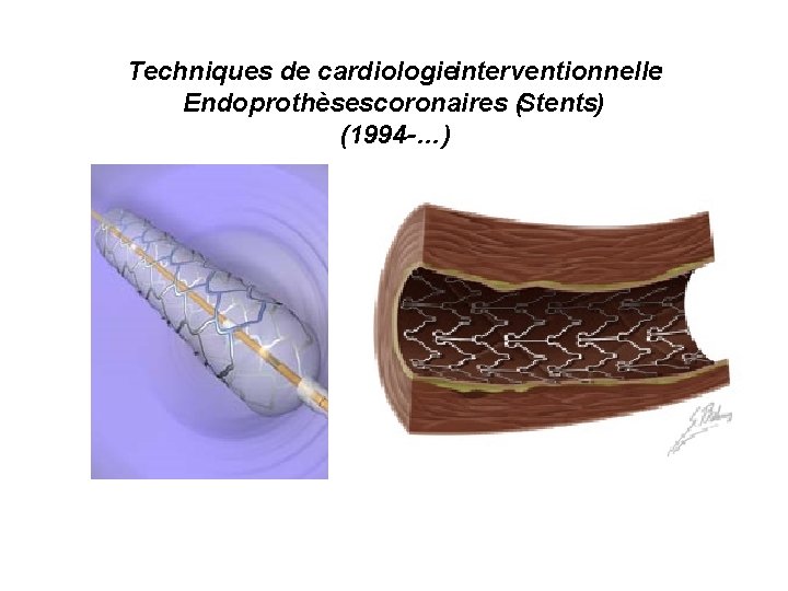 Techniques de cardiologie interventionnelle: Endoprothèses coronaires (Stents) (1994 -…) 