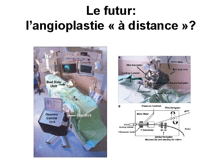 Le futur: l’angioplastie « à distance » ? 