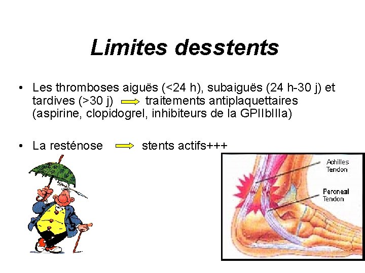 Limites des stents • Les thromboses aiguës (<24 h), subaiguës (24 h-30 j) et