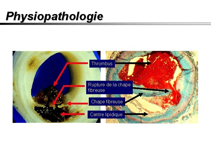 Physiopathologie Thrombus Rupture de la chape fibreuse Centre lipidique 
