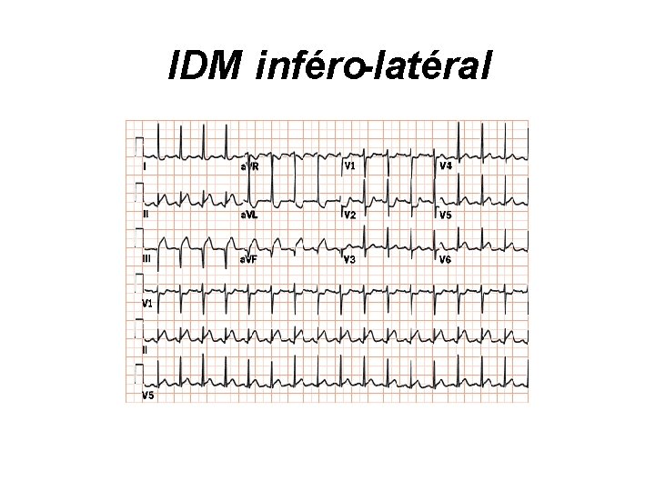IDM inféro-latéral 