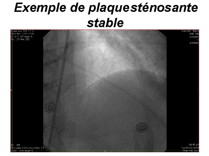 Exemple de plaque sténosante stable 