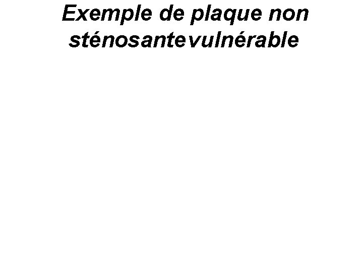 Exemple de plaque non sténosante vulnérable 