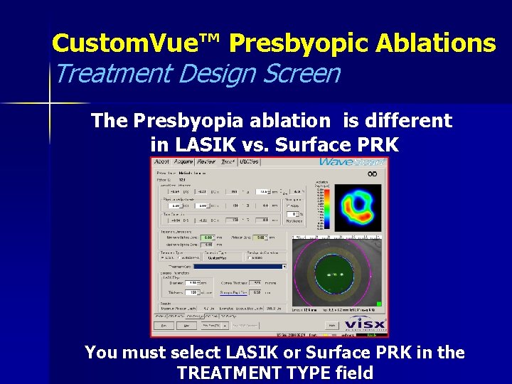 Custom. Vue™ Presbyopic Ablations Treatment Design Screen The Presbyopia ablation is different in LASIK