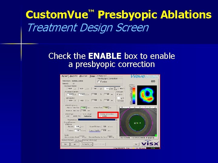 Custom. Vue™ Presbyopic Ablations Treatment Design Screen Check the ENABLE box to enable a