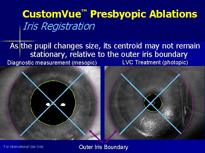 Custom. Vue™ Presbyopic Ablations Iris Registration As the pupil changes size, its centroid may