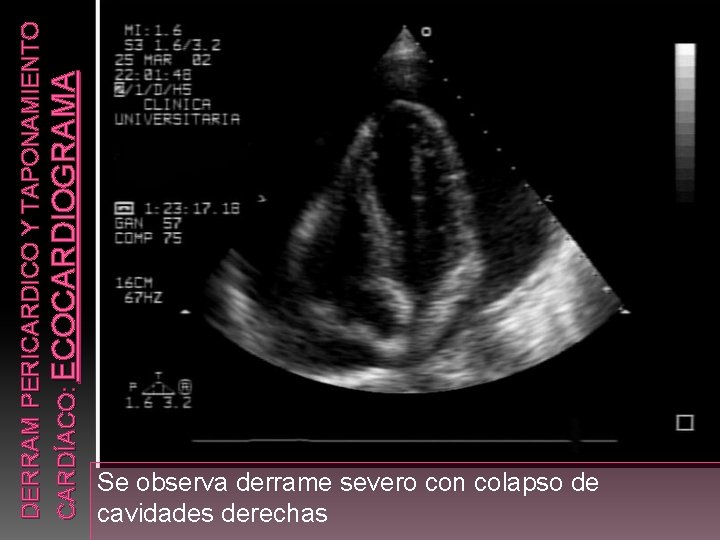 DERRAM PERICARDICO Y TAPONAMIENTO CARDÍACO: ECOCARDIOGRAMA Se observa derrame severo con colapso de cavidades