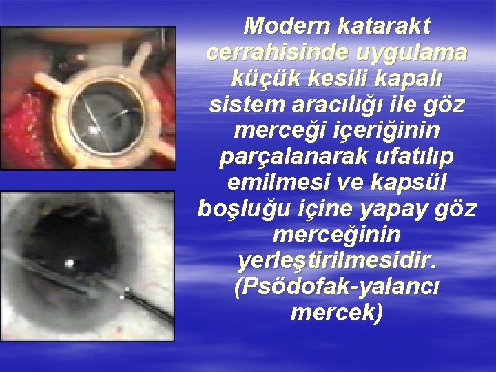Modern katarakt cerrahisinde uygulama küçük kesili kapalı sistem aracılığı ile göz merceği içeriğinin parçalanarak