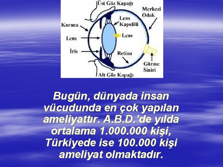 Bugün, dünyada insan vücudunda en çok yapılan ameliyattır. A. B. D. ’de yılda ortalama