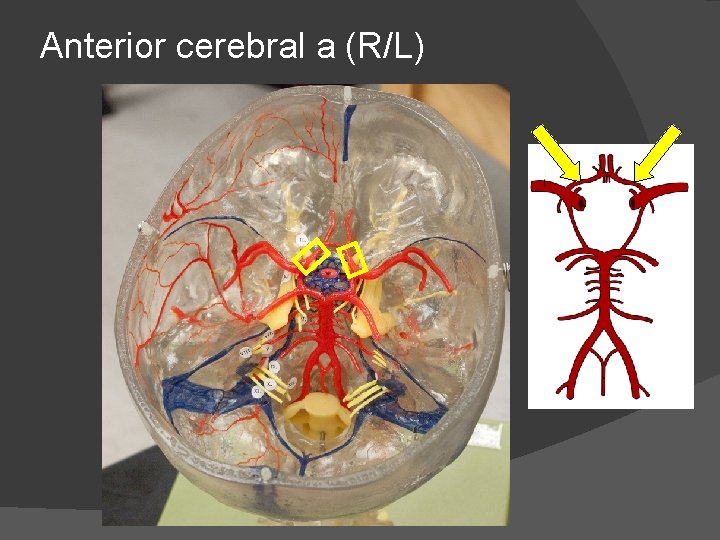 Anterior cerebral a (R/L) 