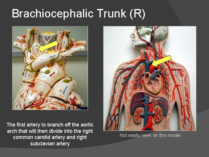 Brachiocephalic Trunk (R) The first artery to branch off the aortic arch that will